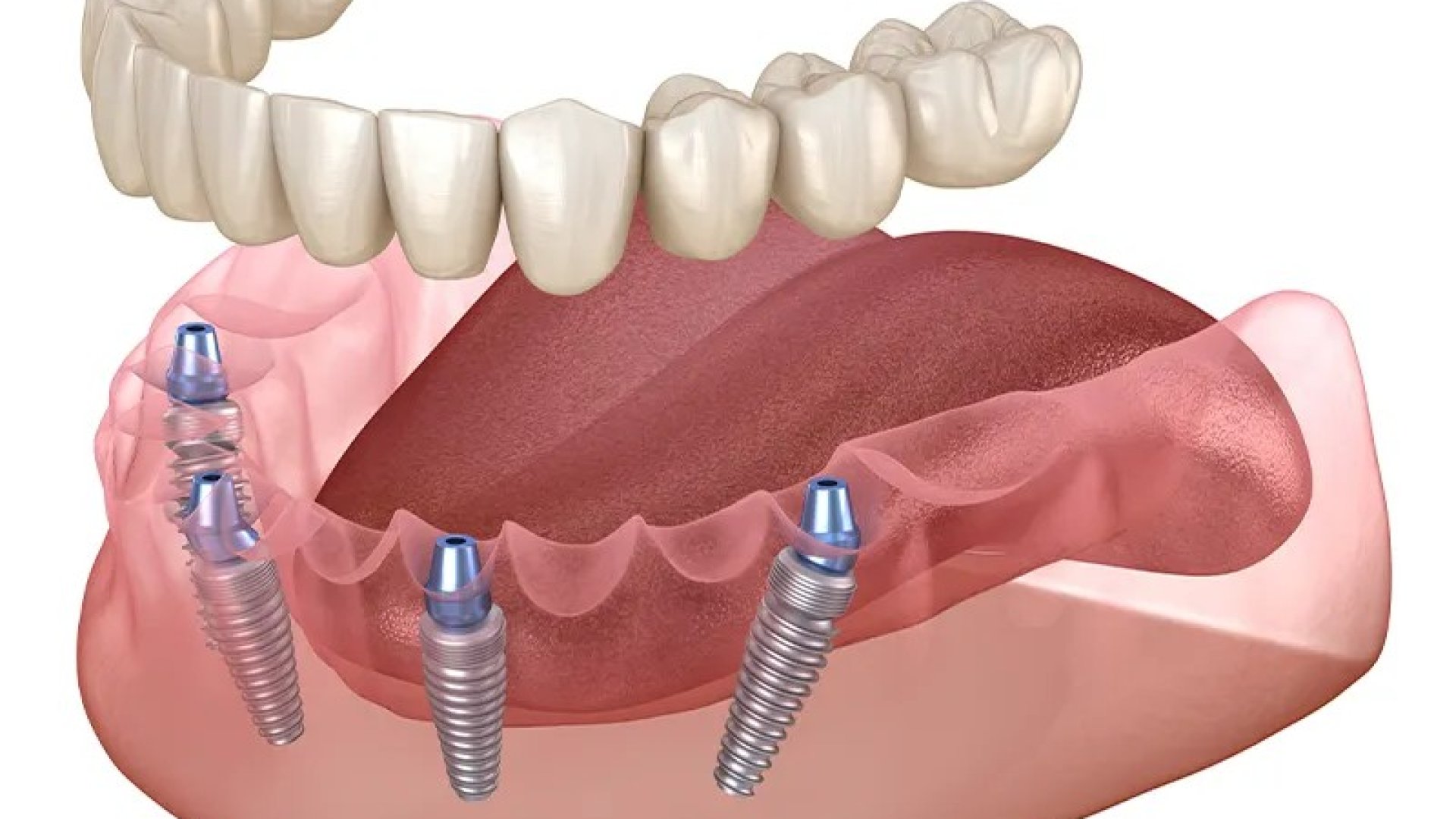 All-on-4 implantáció