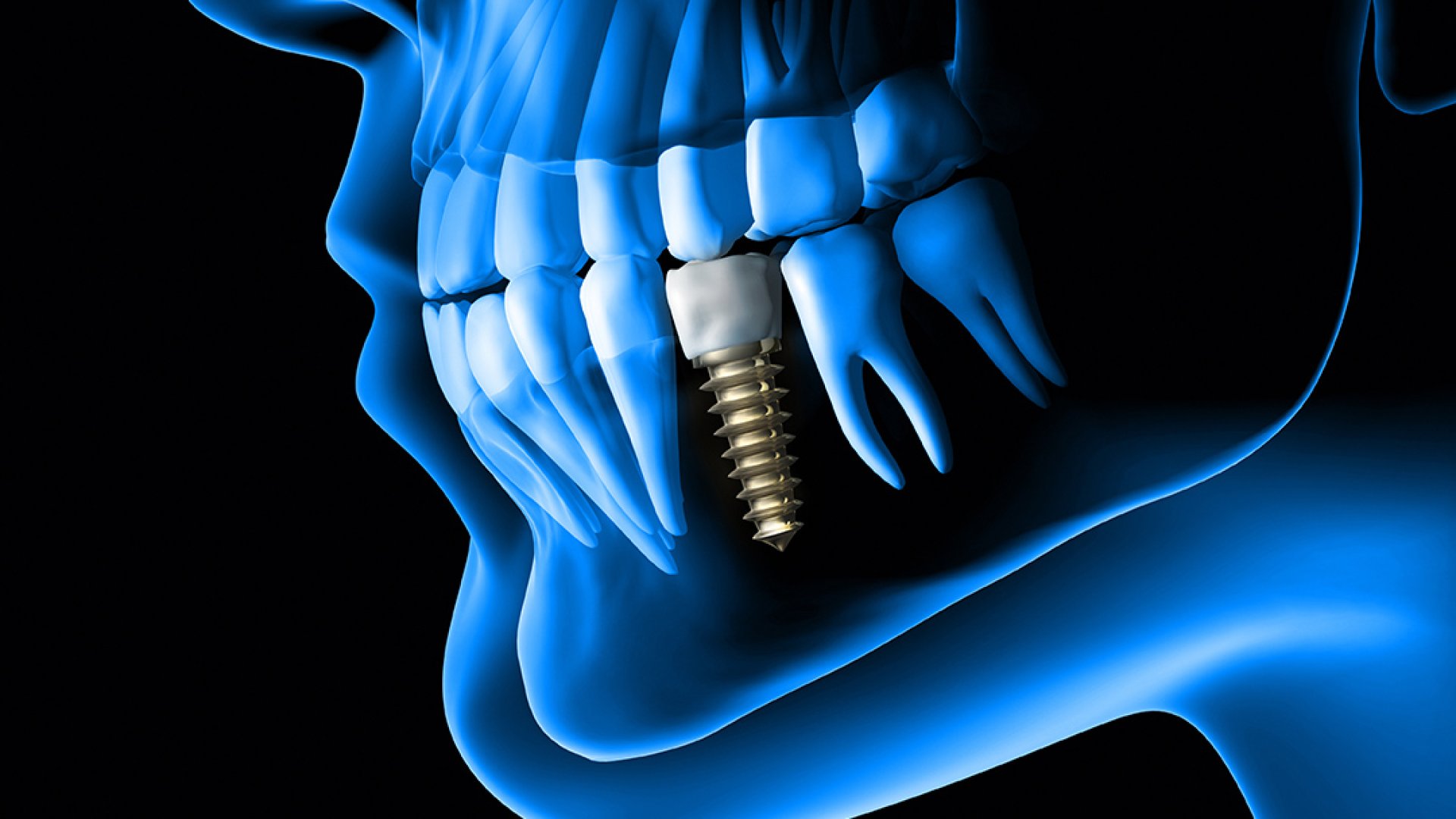 Fogászati implantáció