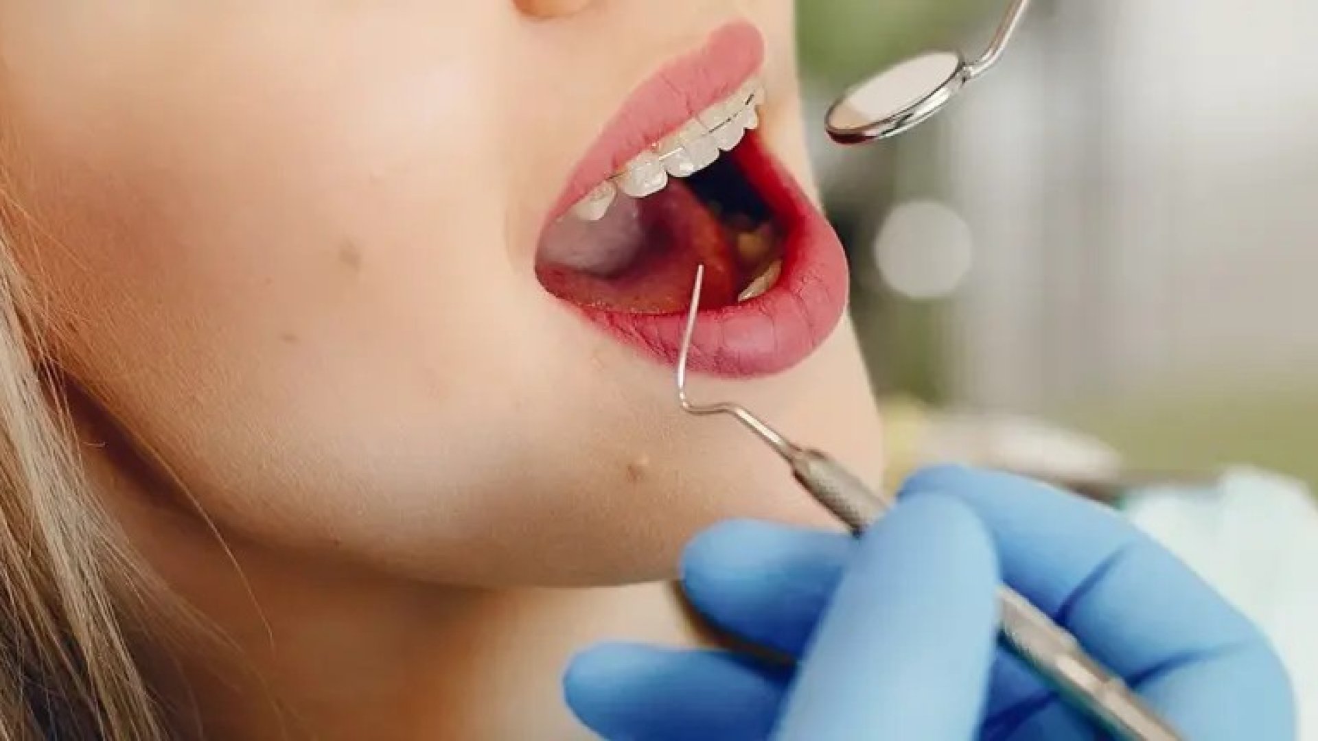Dentálhigiéniai kezelések