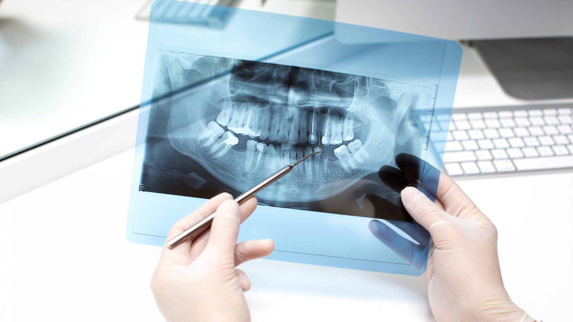 Csontpótlás implantátum előtt | Mikor szükséges? | RózsaDomb DentCare