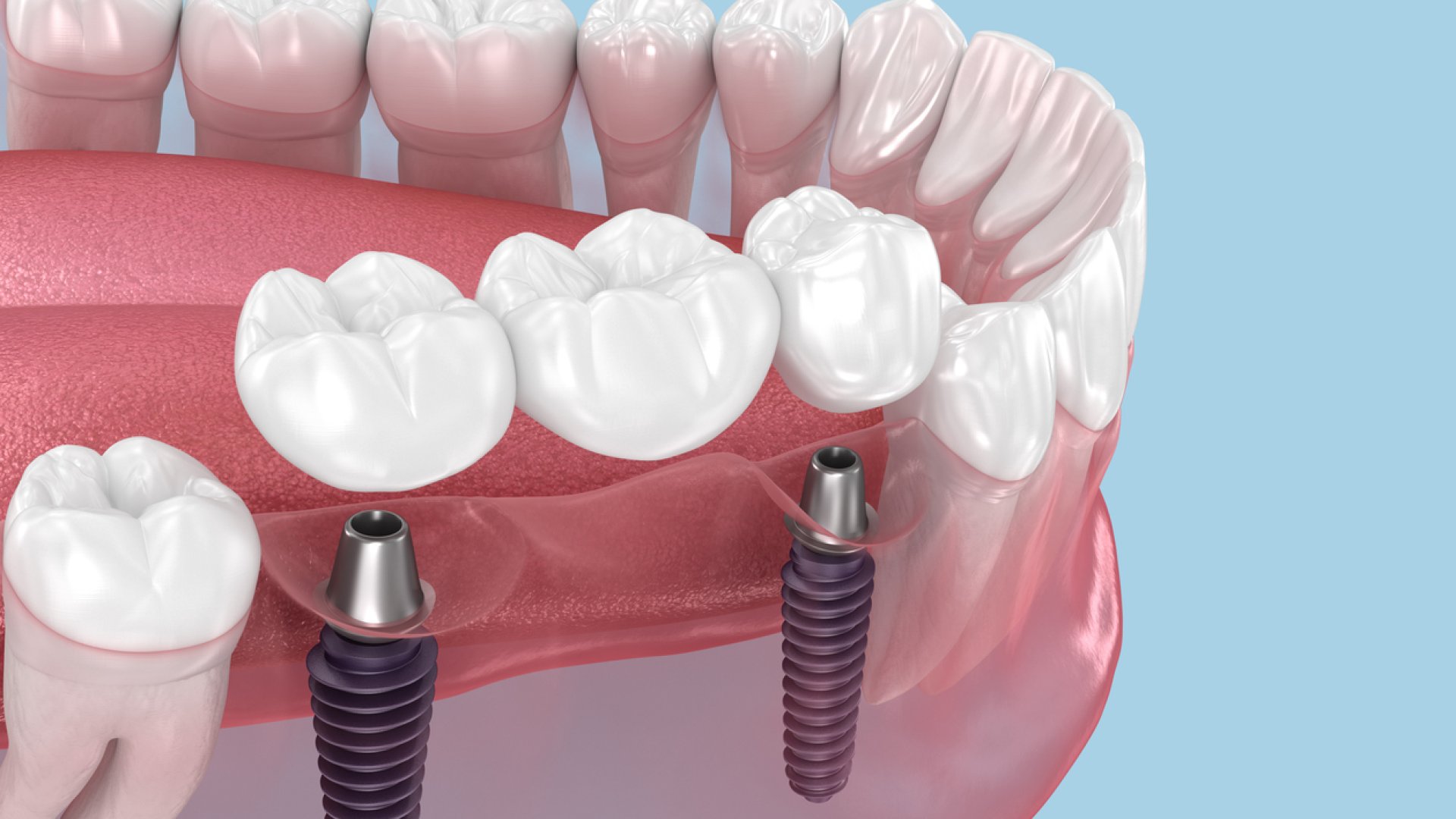 Implantáció ár Budapest – mitől függ a fogbeültetés ára?