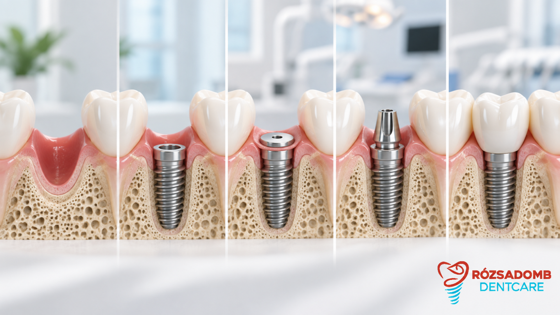Mennyi idő alatt készül el egy fogimplantátum? | Rózsadomb DentCare