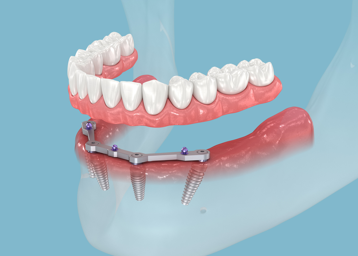 All-on-4 implantátumokra rögzített teljes fogív