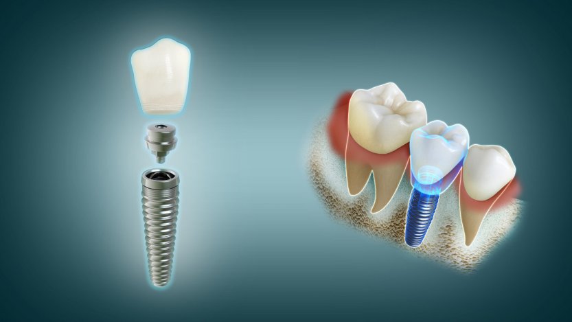navigált implantáció a gyakorlatban