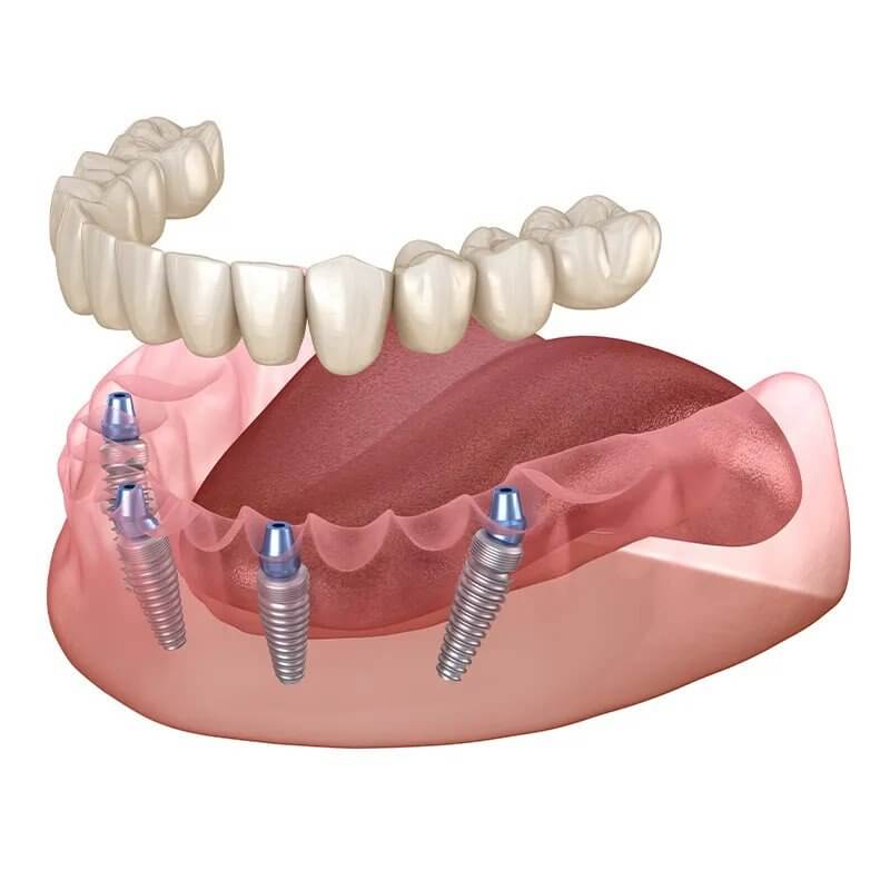 All-on-4 implantáció Budapest