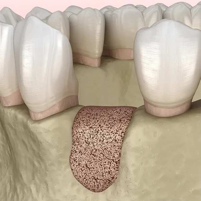 Csontpótlás Budapest – biztos alap az implantációhoz