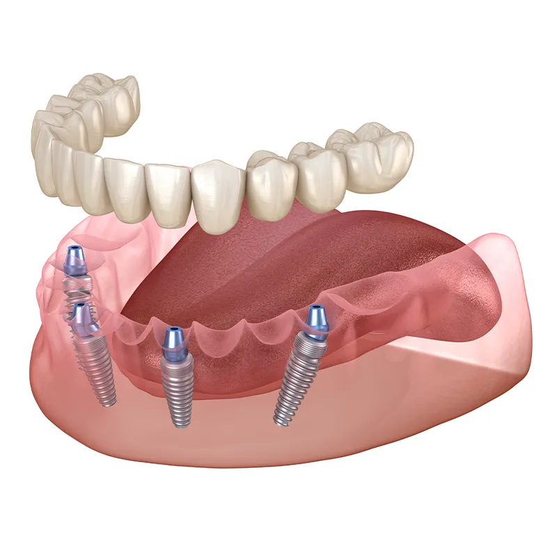 All on 4 implantációs fogpótlás