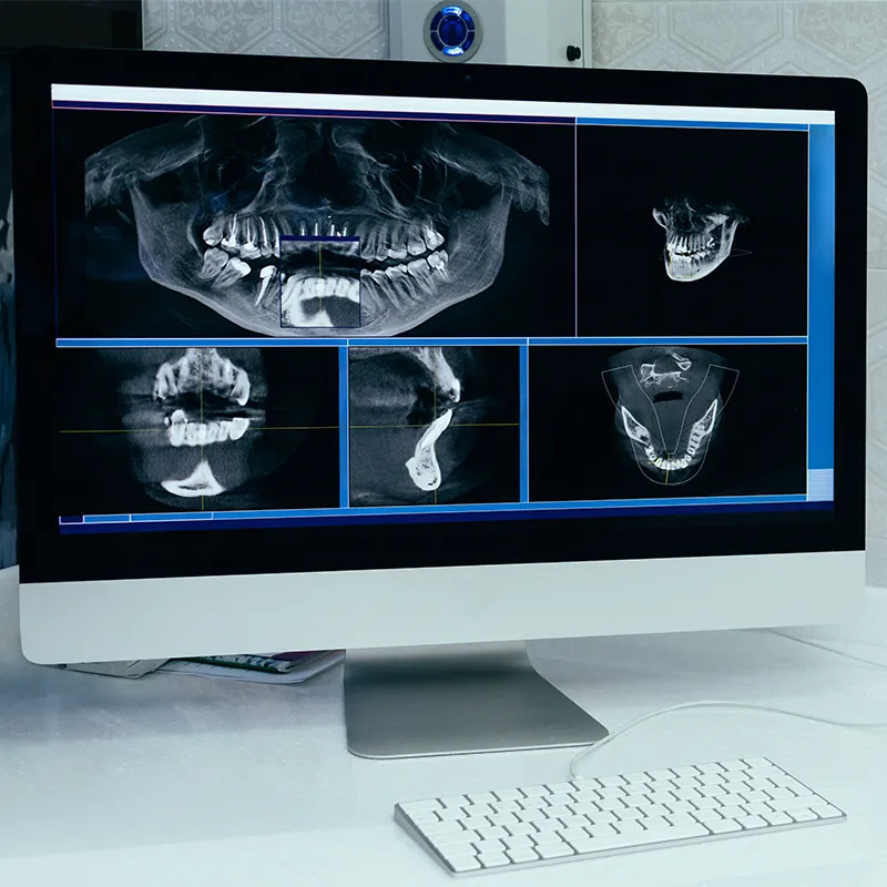 navigációs implantáció