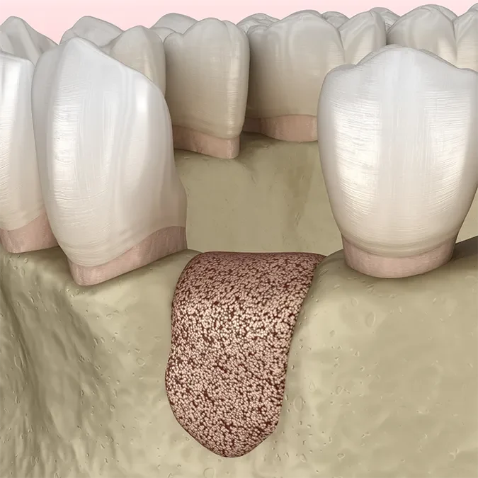 rozsadomb-dentcare-csontpotlas